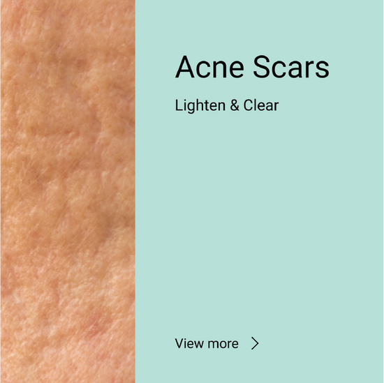 Acne Scars <span>Lighten & Clear</span>