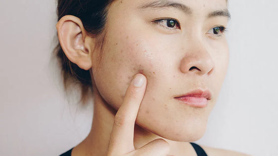 How To Deal With Adult Acne: Experts Weigh In